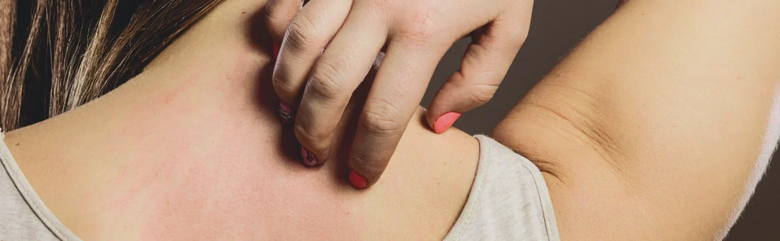 Histamine Intolerance Image